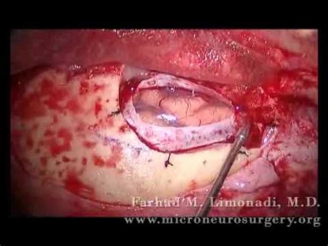 Resection of Metastatic Lung Cancer  brain surgery    YouTube