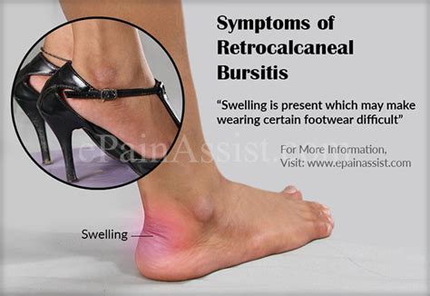 Retrocalcaneal Bursitis|Causes|Symptoms|Treatment|Exercise ...
