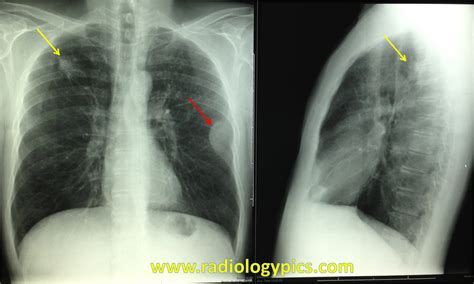 Right Upper Lobe Lung Cancer with Rib Metastasis ...