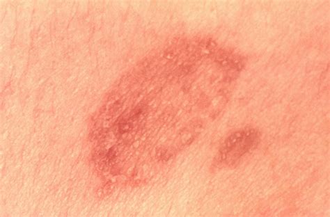 Ringworm Causes Psoriasis and It Is Contagious ...