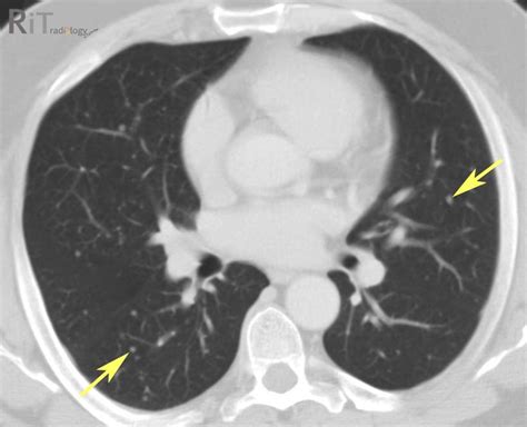 RiT radiology: Miliary Pulmonary Metastasis