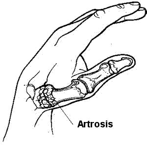 RIZARTROSIS DEL PULGAR