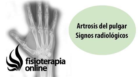 Rizartrosis o artrosis del pulgar   Signos radiológicos ...