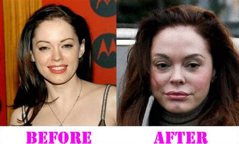 Rose Mcgowan Plastic Surgery Before After Pictures