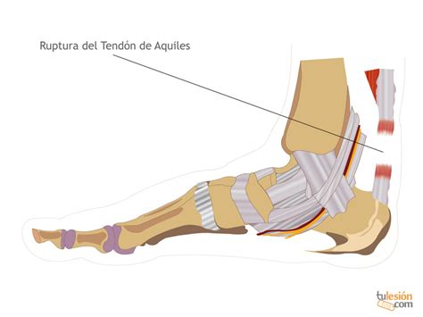 Rotura del tendón de Aquiles, causas y tratamientos.