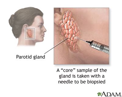 Salivary gland biopsy: MedlinePlus Medical Encyclopedia Image