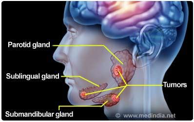 Salivary Gland Cancer Causes Types Symptoms Diagnosis ...