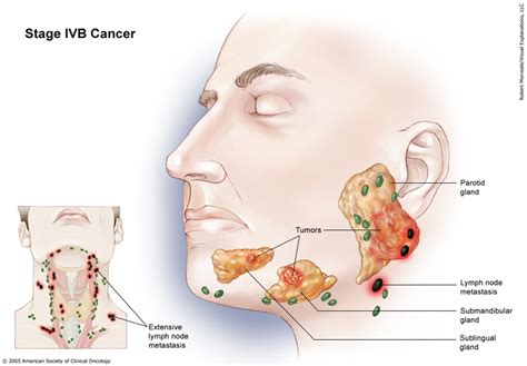 Salivary Gland Cancer: Stages and Grades | Cancer.Net