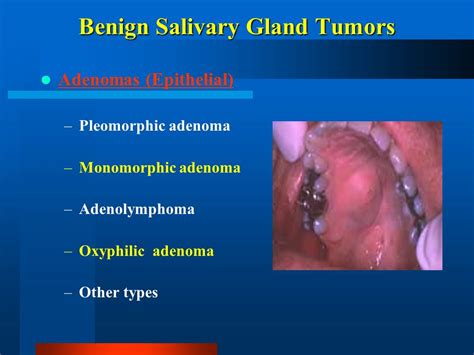 Salivary Gland Diseases   ppt video online download