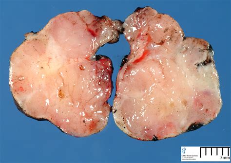 salivary gland tumors   Humpath.com   Human pathology