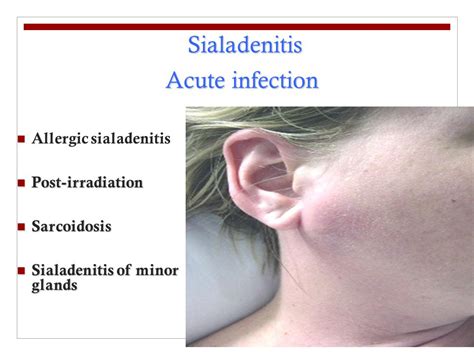 Salivary Glands Disorders   ppt video online download