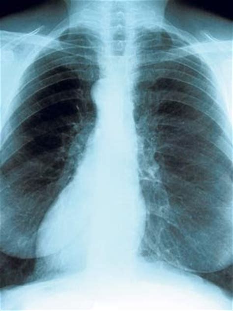 SALUD: Cáncer de pulmón