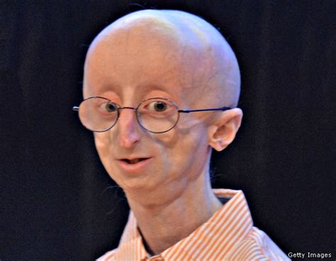 Sam Berns, Teen With Aging Disease Progeria, Dies at 17 ...