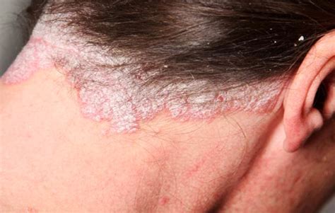 Scalp Psoriasis   Why You Should Be Concerned