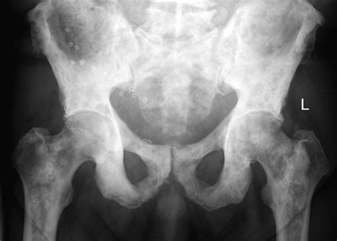 Sclerotic bone metastases from prostate cancer | Image ...