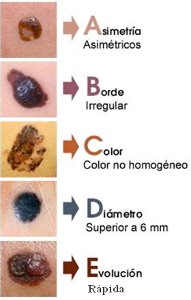 Se Diagnostica El Cáncer De Piel | NewBranch