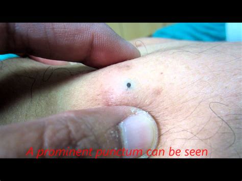 Sebaceous Cyst Removal Video Youtube | www.imgkid.com ...