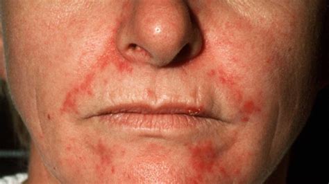 Seborrheic Dermatitis on Face Treatment, Symptoms and Pictures