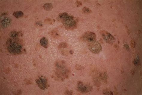 Seborrheic Keratosis: Skin Growth, Symptoms & Treatment