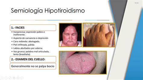 Semiología del Sistema Endocrino Clase 3 Hipotiroidismo ...