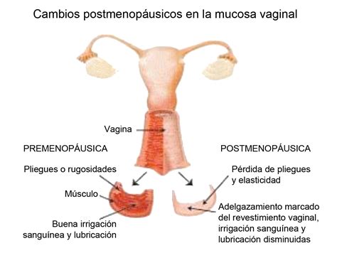Sequedad vaginal en la menopausia y uso de estrógenos ...