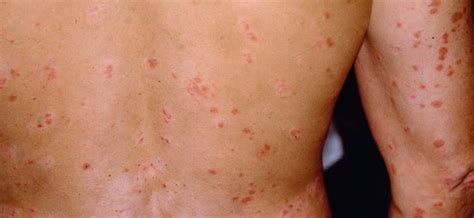 Severas infecciones en la piel por agua sucia en Misantla ...