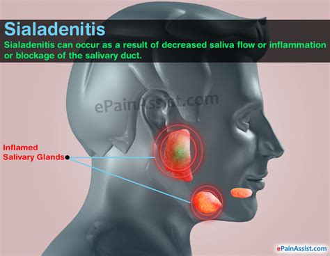 Sialadenitis|Causes|Signs|Symptoms|Treatment|Home Remedies ...