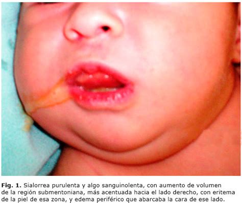 Sialadenitis submandibular supurativa aguda neonatal