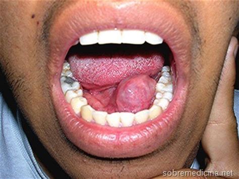 Sialoadenitis, una inflamación de las glándulas salivales ...
