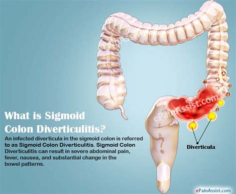 Sigmoid Colon Diverticulitis|Causes|Symptoms|Treatment ...