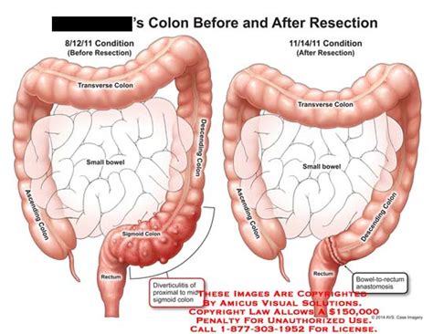 Sigmoid Colon Removal   Anatomy