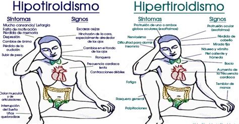 Signos Y Síntomas Del Hipotiroidismo E Hipertiroidismo