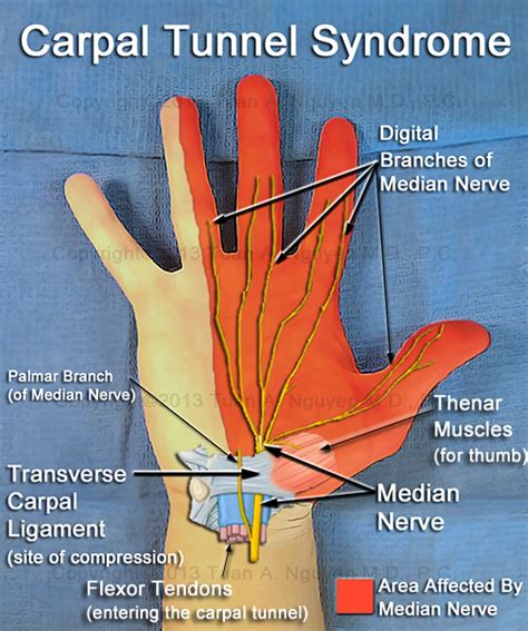 Signs and Symptoms of Carpal Tunnel Syndrome   Portland ...