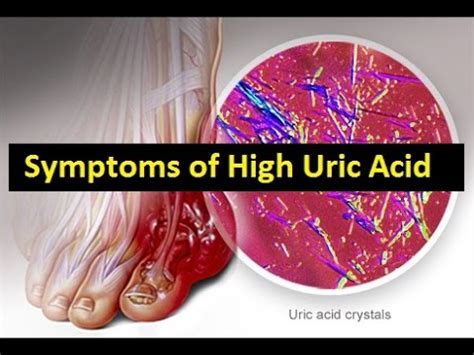 Signs and symptoms of high uric acid, high uric acid ...
