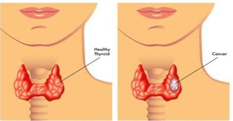 Signs And Symptoms of Throat Cancer in Detail | Care Whizz