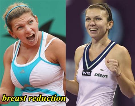 Simona Halep Breast Reduction Before and After   Plastic ...