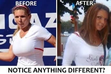 Simona Halep vs Breast Reduction Before & After | Daily Vs ...