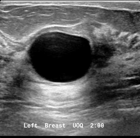 Simple breast cyst | Image | Radiopaedia.org