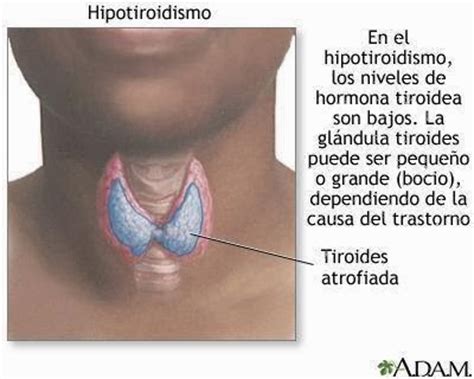 Simplemente Mujer : Hipotiroidismo