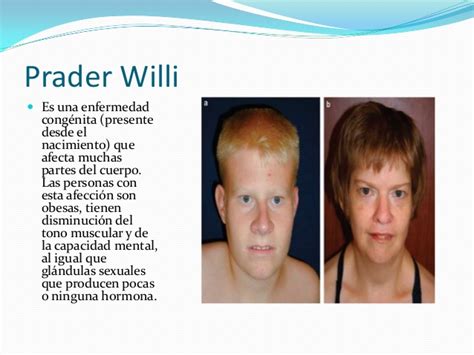 Sindrome Angelman vs Sindrome Prader Willi