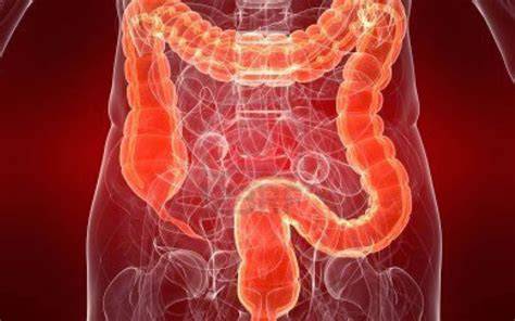 Síndrome de colon irritable   GastroinvestGastroinvest