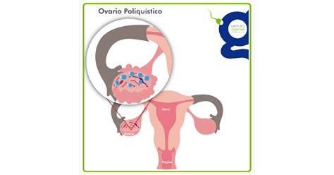 Síndrome de ovario poliquístico  SOP , ¿una causa de ...