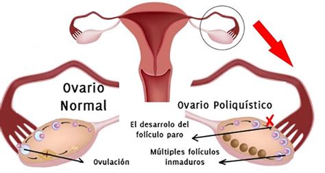 Síndrome de Ovario Poloquístico: Síntomas, Causas y ...