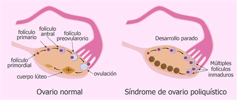 Síndrome de ovarios poliquísticos SOP : causas, síntomas ...