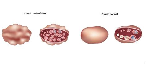 Síndrome de ovarios poliquísticos y embarazo