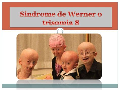 Sindrome de werner o trisomia 8