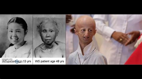 Sindrome di Werner e Progeria a confronto.   YouTube