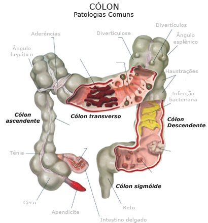 Síndrome do Intestino Irritável: Características Gerais ...