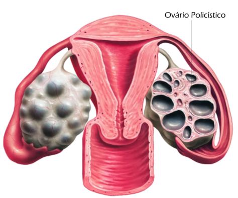 Síndrome do ovário policístico e a infertilidade