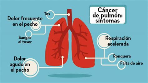 síntomas cáncer de pulmón   Genial Con salud